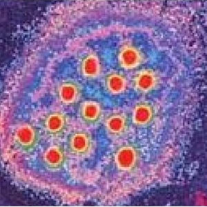 Вирус гепатита А –  антитела IgM