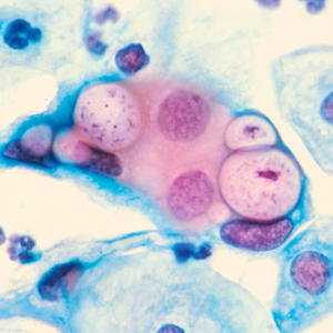 Антитела IgA к хламидии (Chlamydia trachomatis)